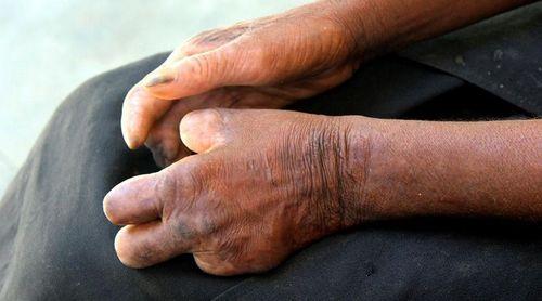 Lepra: Sensibilização das pessoas em procurar estruturas de saúde é o principal desafio - Coordenadora 