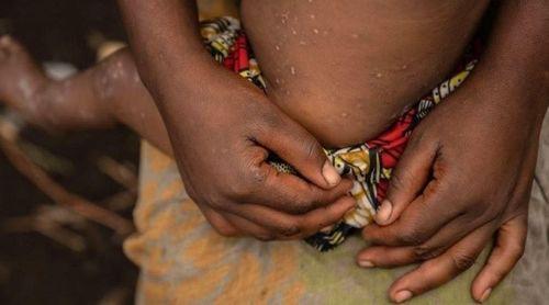 Detectado primeiro caso de nova variante de mpox nos EUA