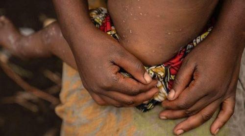 Nova variante da Mpox transmitida principalmente entre humanos